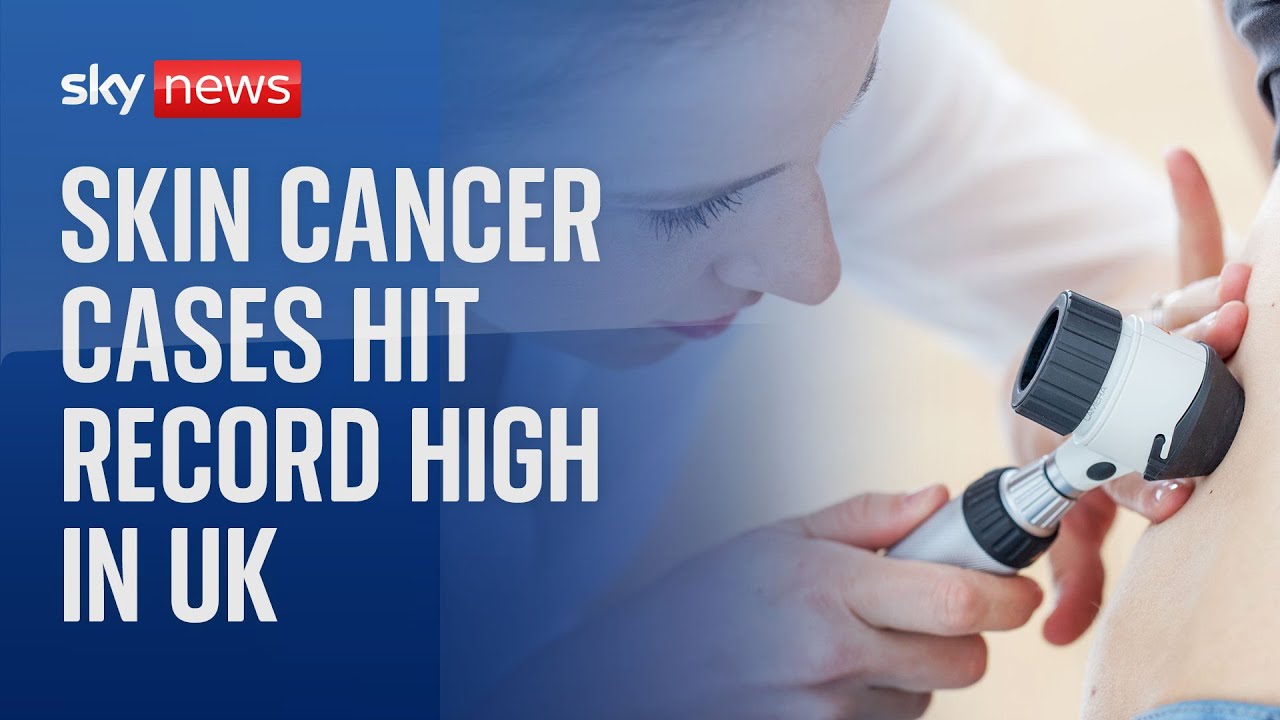 Melanoma skin cancer cases at all-time high in UK - World News